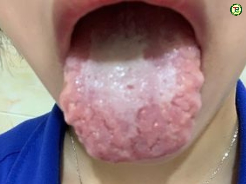 Nhiễn nấm, nhiệm khuẩn là nguyên nhân chủ yếu gây ra nứt lưỡi.